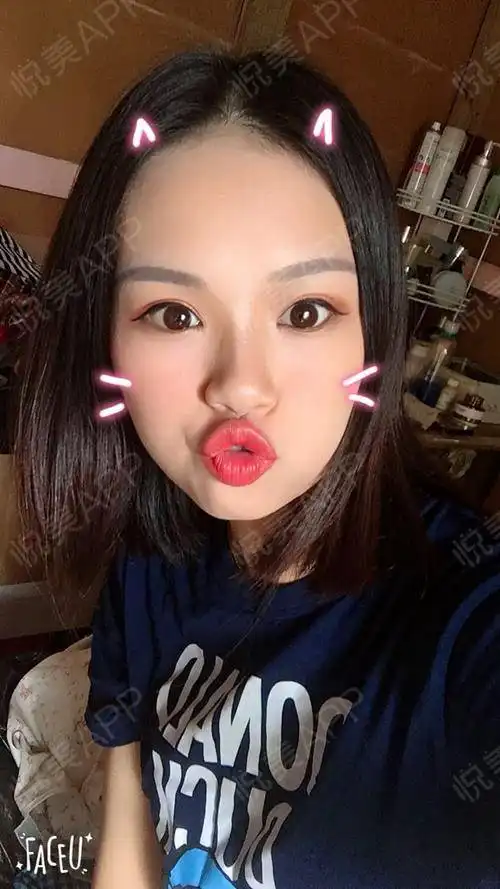 来贡献一组表情包,闺蜜说好像邓紫棋的金鱼双眼皮宽...眼型矫正悦美整形