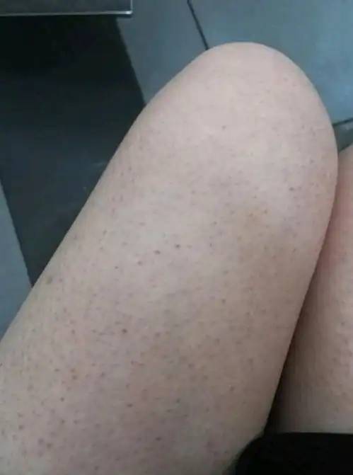 大腿鸡皮肤怎么治疗相信这些答案你会满意
