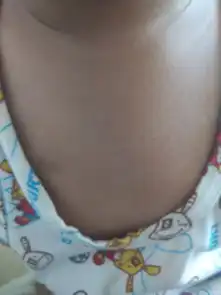 2岁小儿,胸口的疹子是什么