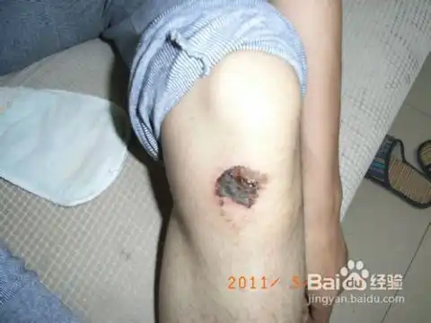 女生膝盖受伤该怎么办