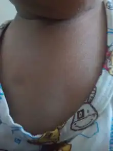 2岁小儿,胸口的疹子是什么