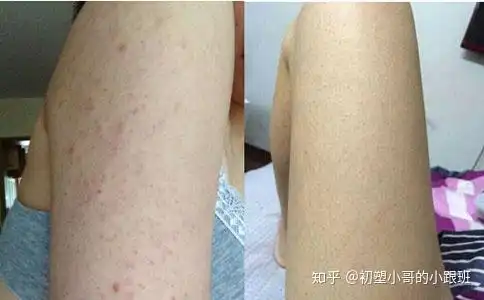去鸡皮肤最有效的方法