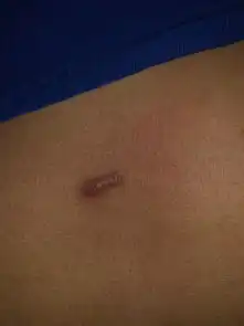 胸口出了个红疙瘩,不知道这是什么,之前很小现在大了,之前不疼不痒,现在用力摁着疼