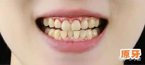 它来了无需磨牙的瓷贴面
