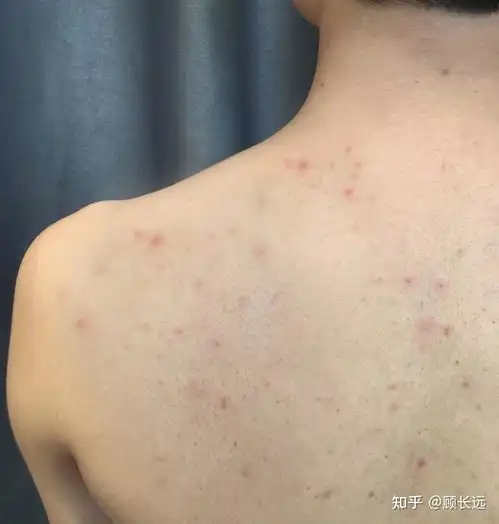 后背,胸口上长满小痘痘,这是什么情况该如何解决