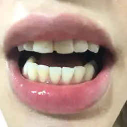 门牙掉了一个角可以补吗大概多少钱容易脱落吗