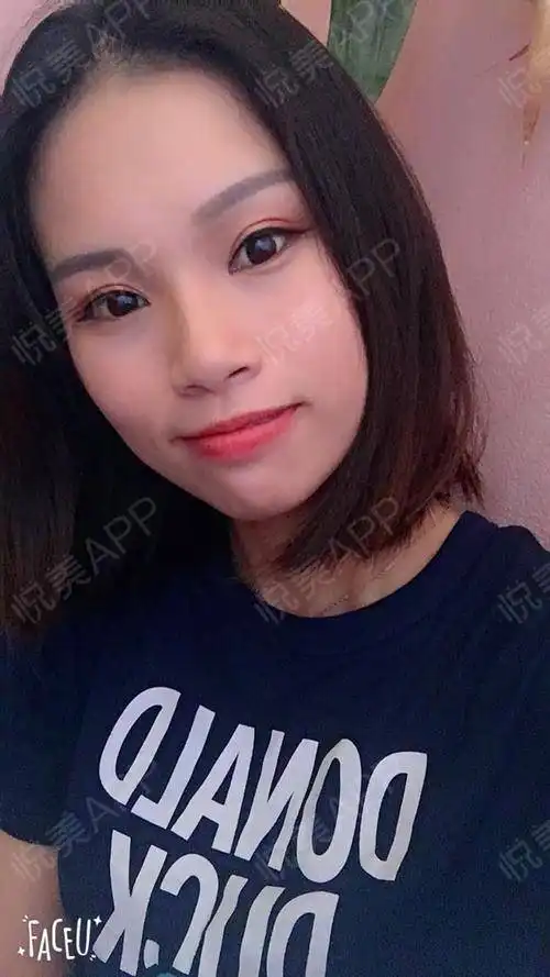 来贡献一组表情包,闺蜜说好像邓紫棋的金鱼双眼皮宽...眼型矫正悦美整形