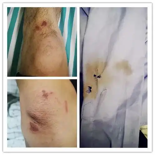 女生摔倒膝盖受伤图片