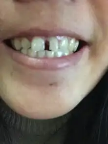 门牙掉了一半,怎么办才好