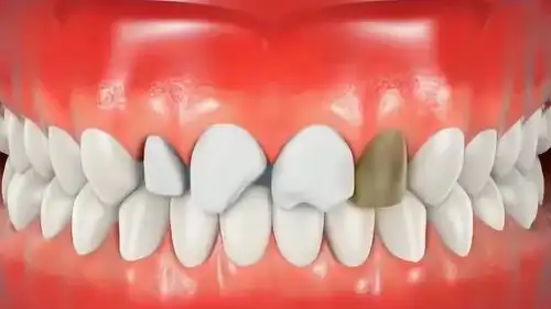 不小心门牙磕掉了一小半怎么办,补牙把你变成美女,3d动画演示全过程