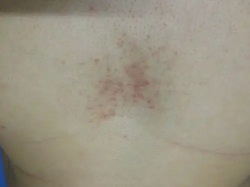 胸口长痘痘怎么回事,红色的小痘痘像青春痘一样,出汗就痒痒