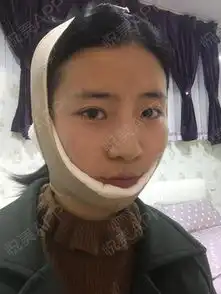 对于一个女生来来说,胖真的是不太能忍受的一件事情,...瘦脸悦美整形