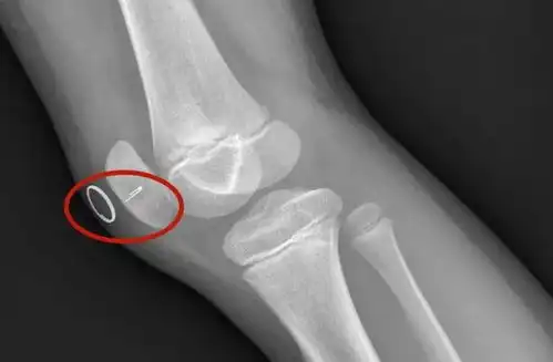 杭州一8岁女孩滑倒后走路困难,竟在她膝盖里发现了