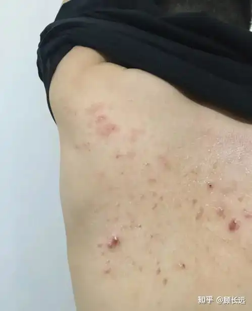 后背,胸口上长满小痘痘,这是什么情况该如何解决