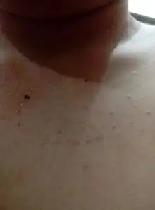 身上起小疙瘩是怎么回事啊在在胸口那块起了得有一个礼拜了吧,现在身上又起了好几个擦了皮炎平还有