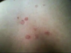 胸口的小疙瘩变成了红圈圈