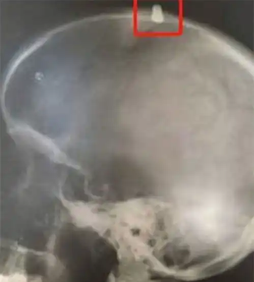 跑马拉松被子弹击中头部,他误以为是石头,顶着大包跑完全程