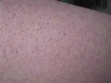 鸡皮肤大腿图片