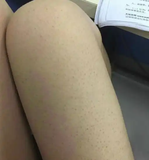 去鸡皮肤最有效的方法日常妙招养出牛奶肌
